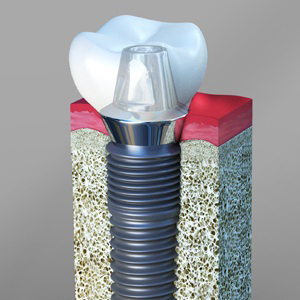Are Dental Implants Safe Stuart