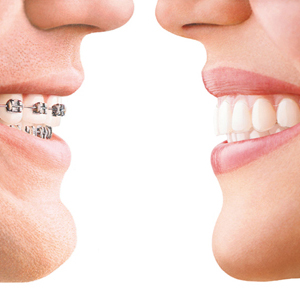 Invisalign Vs Dental Braces Which Is Right For You? | Stuart, FL