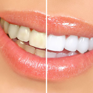 Teeth Whitening: Benefits and Procedure | Stuart, FL