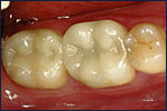 Dental Crown After Image
