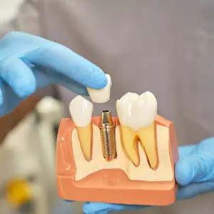 Helpful dental information about dental implants in Stuart