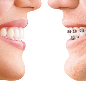 Braces or Invisalign: Which Is Preferable? | Stuart, FL