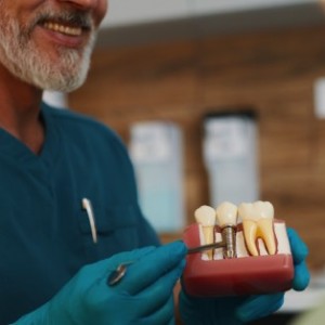 Common Questions About Dental Implants in Stuart