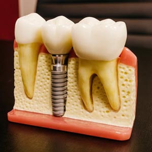 Emergency Dental Implants: How to Get the Care You Need