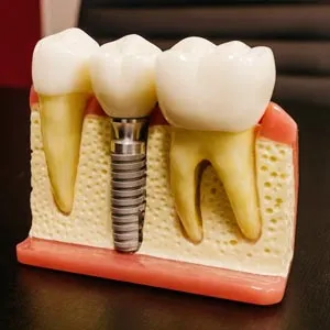 Emergency Dental Implants: How to Get the Care You Need