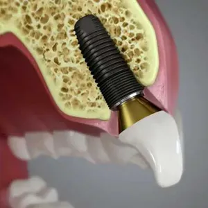 Top 7 Myths About Dental Implants in Stuart Debunked