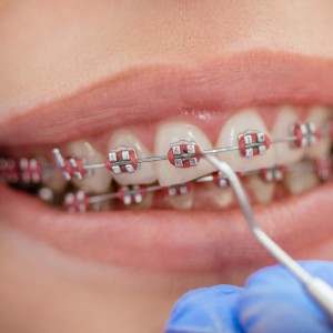 Top Benefits of Getting Dental Braces in Stuart