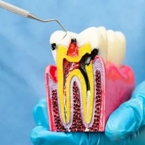 Top Benefits of Root Canal Treatment in Stuart