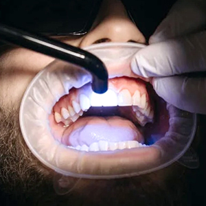What to Expect After a Teeth Whitening Treatment?