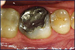 Dental Crown Before Image