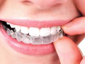 Invisalign FAQ