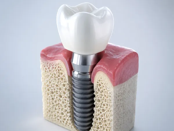 Dental Implants