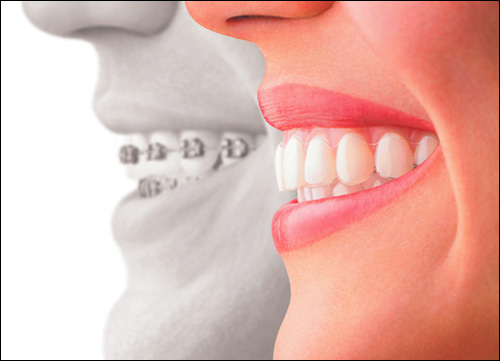 Invisalign Braces Stuart FL