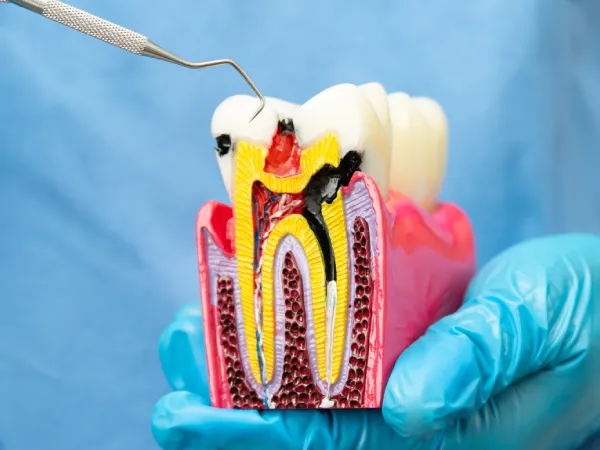 Root Canal Treatment